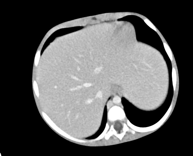Abdominopelvic rhabdomyosarcoma (Radiopaedia 78356-90984 Axial C+ portal venous phase 42).jpg