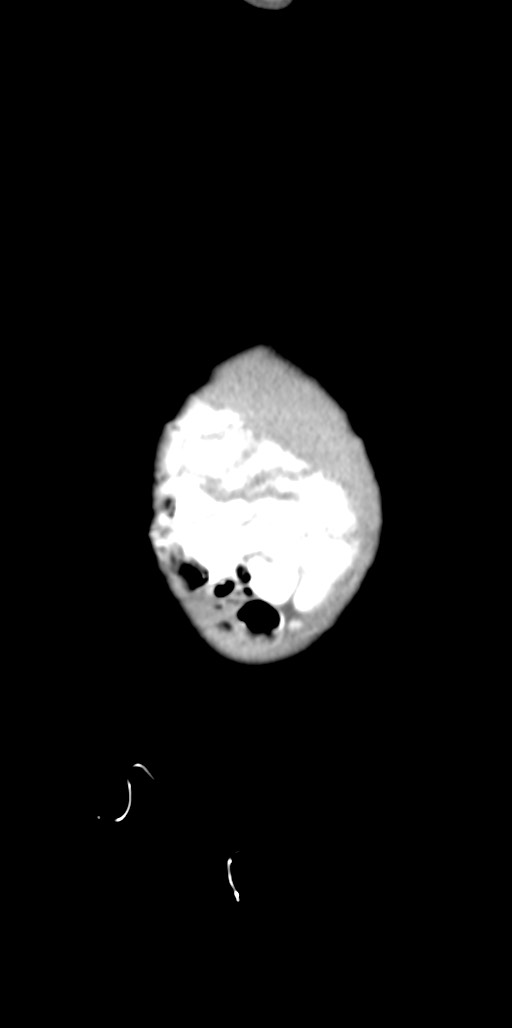 Abdominopelvic rhabdomyosarcoma (Radiopaedia 78356-90984 Sagittal C+ portal venous phase 97).jpg
