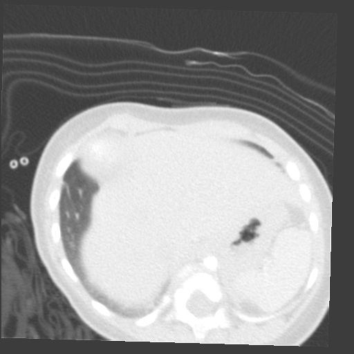 File:Aberrant left pulmonary artery (pulmonary sling) (Radiopaedia 42323-45435 Axial lung window 36).jpg