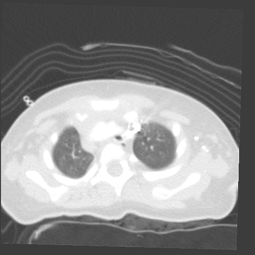 File:Aberrant left pulmonary artery (pulmonary sling) (Radiopaedia 42323-45435 Axial lung window 7).jpg