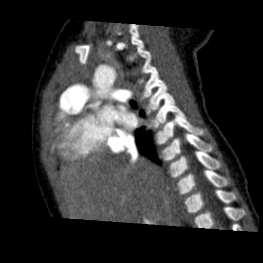Aberrant left pulmonary artery (pulmonary sling) (Radiopaedia 42323-45435 Sagittal C+ arterial phase 24).jpg