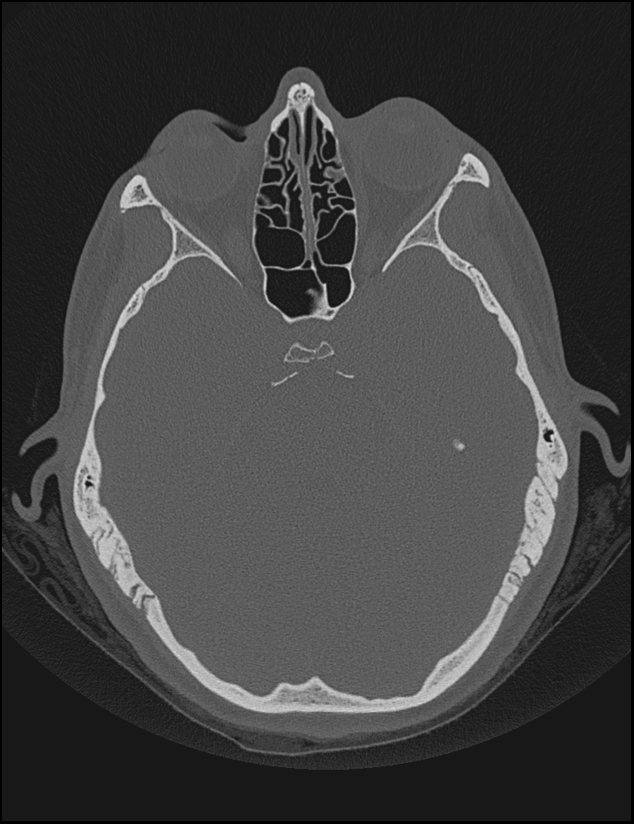 Aberrant right internal carotid artery (Radiopaedia 65191-74198 Axial non-contrast 62).jpg
