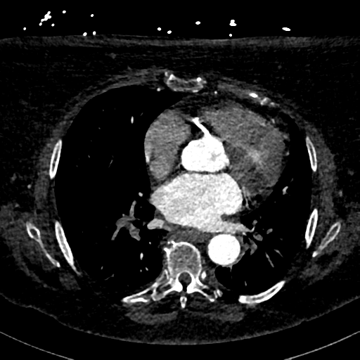 File:Aberrant right subclavian artery with Kommerell diverticulum (Radiopaedia 47982-52769 Axial C+ arterial phase 54).png