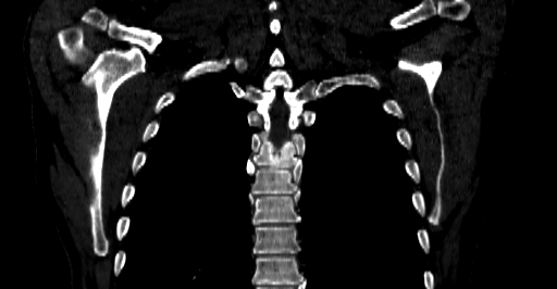 Accesory rib joint (Radiopaedia 71987-82452 Coronal bone window 48).jpg