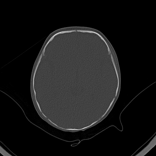 File:Accessory intraparietal suture (Radiopaedia 50584-56020 Axial bone window 20).jpg