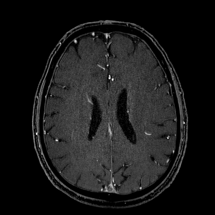 Accessory middle cerebral artery (Radiopaedia 73114-83828 Axial MRA 139).jpg