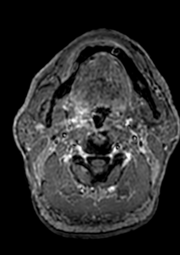 Accessory middle cerebral artery (Radiopaedia 73114-83828 Axial T1 C+ 280).jpg