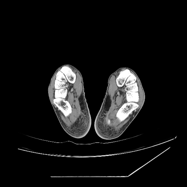 Accessory soleus muscle (Radiopaedia 61069-68943 Axial non-contrast 72).jpg