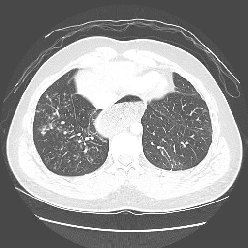 Achalasia (Radiopaedia 52507-58417 Axial lung window 49).jpg