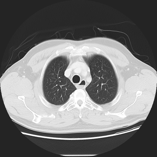 File:Achalasia (Radiopaedia 8831-9629 Axial lung window 17).jpg