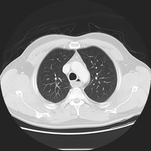 Achalasia (Radiopaedia 8831-9629 Axial lung window 20).jpg