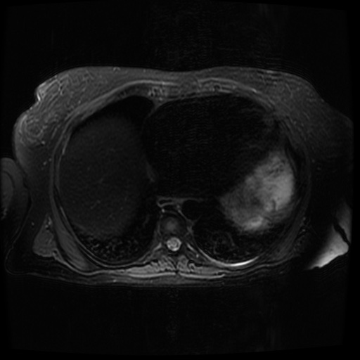 File:Acinar cell carcinoma of the pancreas (Radiopaedia 75442-86668 Axial T2 fat sat 9).jpg