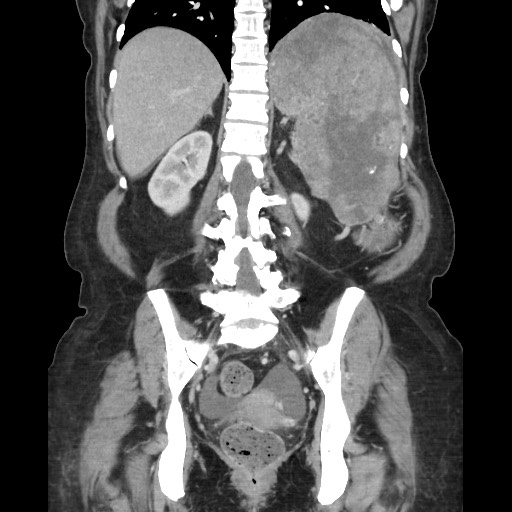 File:Acinar cell carcinoma of the pancreas (Radiopaedia 75442-86669 Coronal C+ portal venous phase 89).jpg