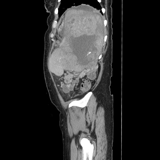 Acinar cell carcinoma of the pancreas (Radiopaedia 75442-86669 Sagittal C+ portal venous phase 160).jpg
