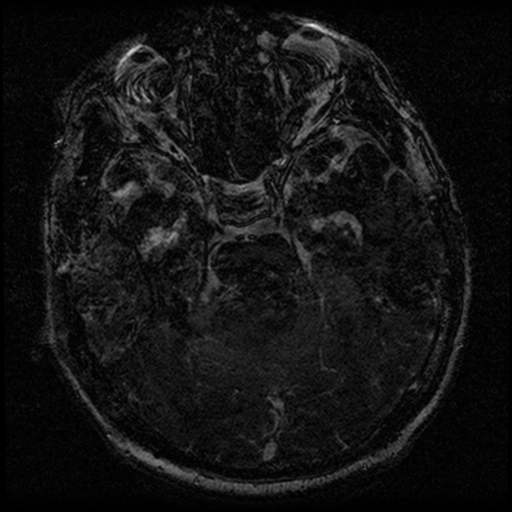 File:Acoustic schwannoma (Radiopaedia 39170-41387 Axial FIESTA 108).png