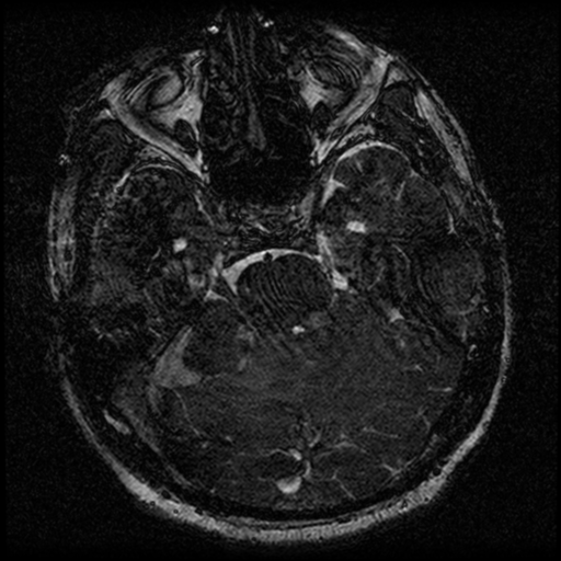 File:Acoustic schwannoma (Radiopaedia 39170-41387 Axial FIESTA 89).png