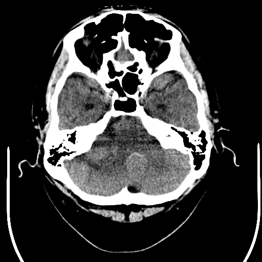 File:Acoustic schwannoma (Radiopaedia 39170-41389 Axial non-contrast 6).png