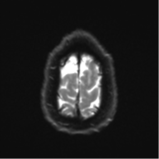 Acoustic schwannoma (Radiopaedia 55729-62281 E 26).png