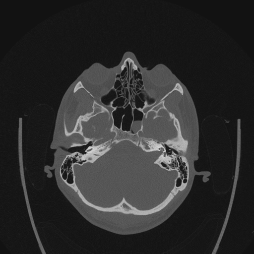 Acoustic schwannoma (translabyrinthine resection) (Radiopaedia 43570-46970 Coronal bone window 1).png