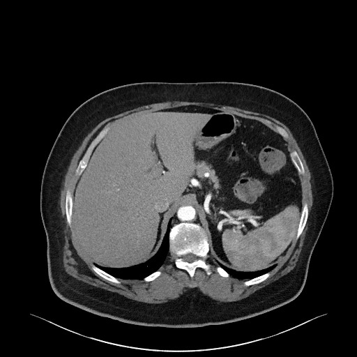 Acromioclavicular joint cyst (Radiopaedia 58455-65610 Axial C+ arterial phase 98).jpg