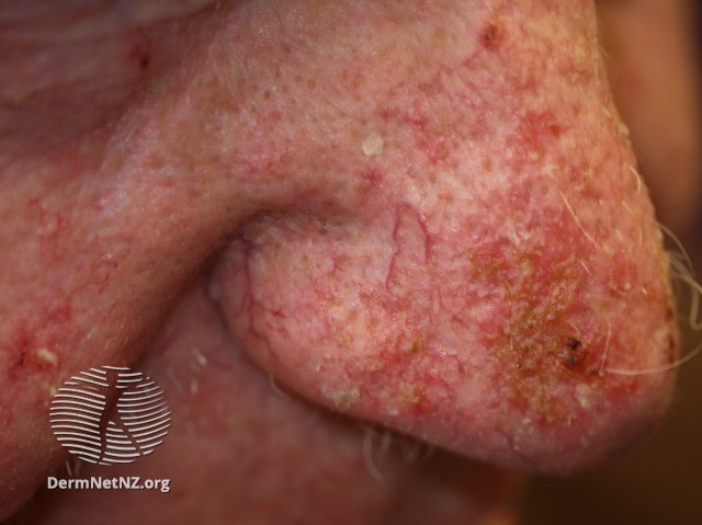 Actinic Keratoses affecting the face (DermNet NZ lesions-ak-face-429).jpg