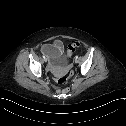 File:Active Crohn disease (Radiopaedia 59394-66750 Axial C+ portal venous phase 62).jpg