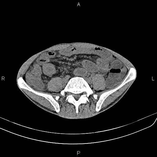 Active crohn disease (Radiopaedia 87133-103397 Axial non-contrast 68).jpg
