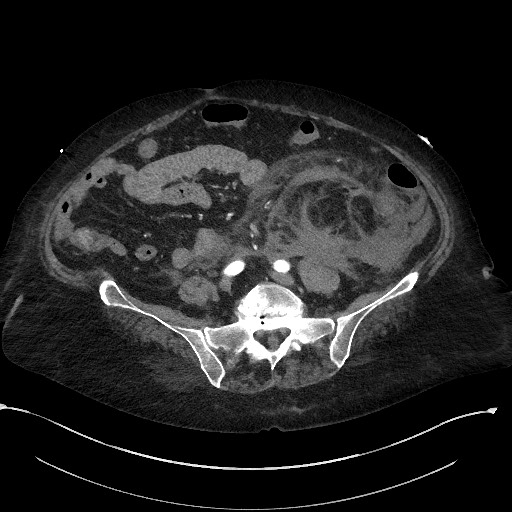 File:Active renal extravasation with large subcapsular and retroperitoneal hemorrhage (Radiopaedia 60975-68796 Axial C+ arterial phase 129).jpg