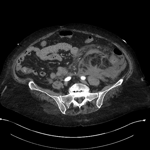 File:Active renal extravasation with large subcapsular and retroperitoneal hemorrhage (Radiopaedia 60975-68796 Axial C+ arterial phase 130).jpg