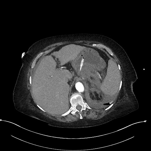 File:Active renal extravasation with large subcapsular and retroperitoneal hemorrhage (Radiopaedia 60975-68796 Axial C+ arterial phase 44).jpg