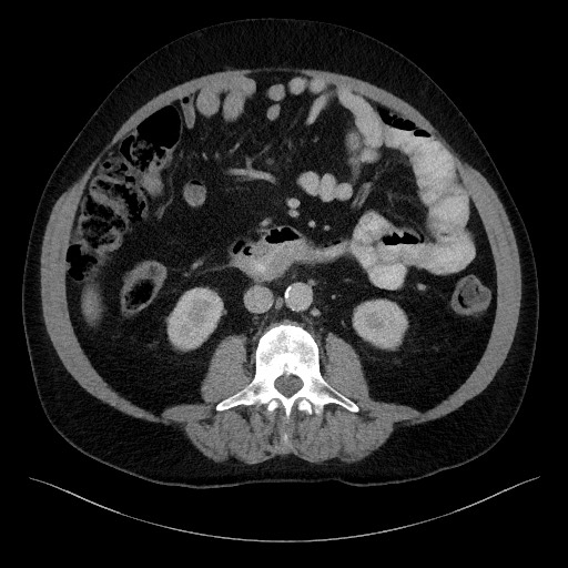 Acute-on-chronic pancreatitis (Radiopaedia 67286-76656 Axial C+ portal venous phase 40).jpg