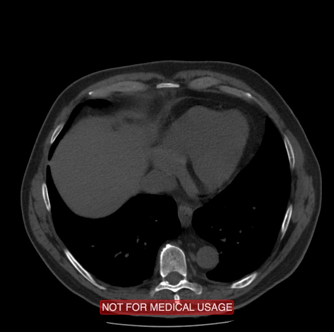 Acute aortic dissection - Stanford type A (Radiopaedia 40661-43285 Axial non-contrast 52).jpg