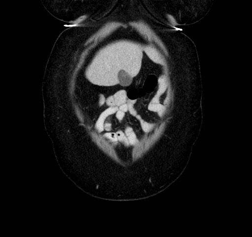 Acute appendicitis, heterotaxy syndrome (Radiopaedia 66884-76202 Coronal C+ portal venous phase 14).jpg