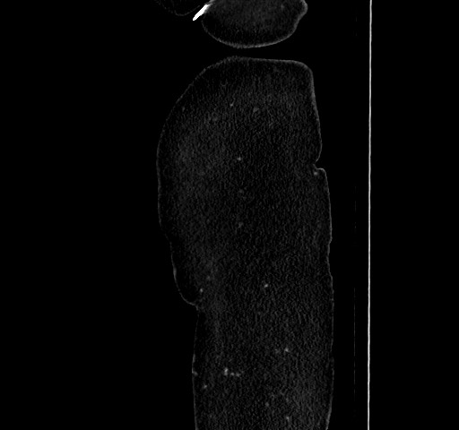 File:Acute appendicitis, heterotaxy syndrome (Radiopaedia 66884-76202 Sagittal C+ portal venous phase 12).jpg