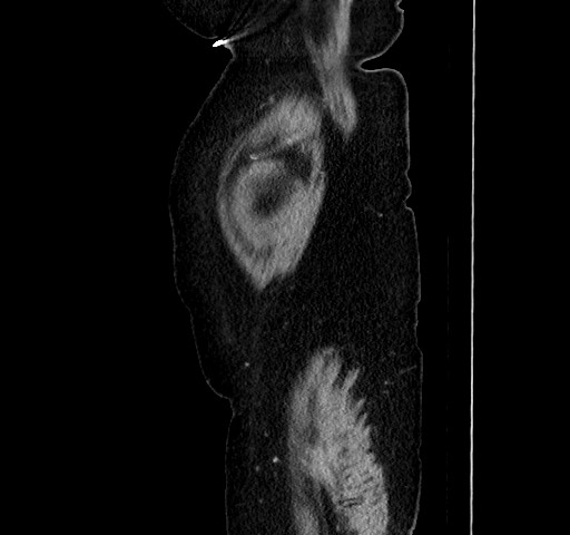 Acute appendicitis, heterotaxy syndrome (Radiopaedia 66884-76202 Sagittal C+ portal venous phase 18).jpg