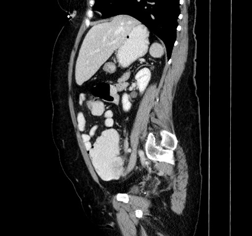 Acute appendicitis, heterotaxy syndrome (Radiopaedia 66884-76202 Sagittal C+ portal venous phase 55).jpg