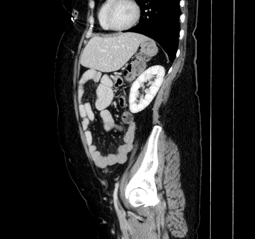 Acute appendicitis, heterotaxy syndrome (Radiopaedia 66884-76202 Sagittal C+ portal venous phase 94).jpg