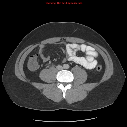 Acute appendicitis (Radiopaedia 10498-10973 Axial C+ portal venous phase 8).jpg