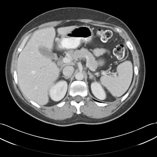 Acute appendicitis (Radiopaedia 30297-30934 Axial C+ portal venous phase 22).jpg