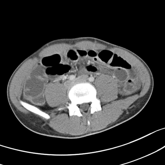 Acute appendicitis (Radiopaedia 32614-33572 Axial C+ portal venous phase 41).jpg