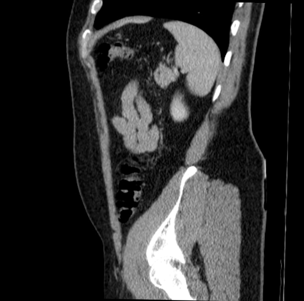 Acute appendicitis (Radiopaedia 38255-40270 Sagittal C+ portal venous phase 66).jpg