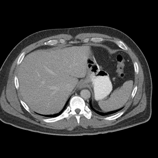 Acute appendicitis (Radiopaedia 48511-53463 Axial C+ portal venous phase 19).jpg