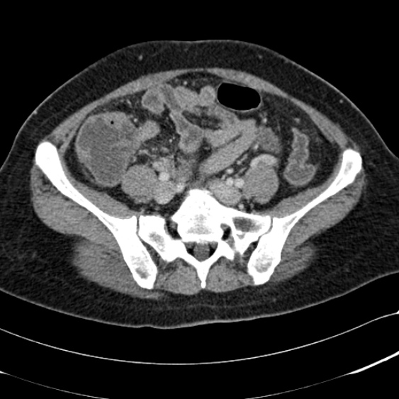 Acute appendicitis (Radiopaedia 48792-53822 Axial C+ portal venous phase 82).jpg