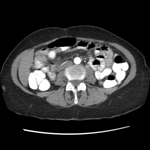 File:Acute appendicitis (Radiopaedia 52672-58589 Axial C+ arterial phase 3).jpg