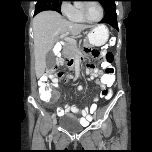 Acute appendicitis (Radiopaedia 52672-58589 Coronal C+ portal venous phase 33).jpg