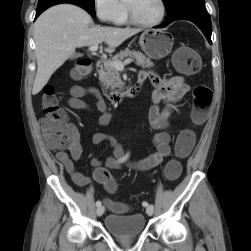 Acute appendicitis (Radiopaedia 66513-75790 Coronal C+ portal venous phase 30).jpg