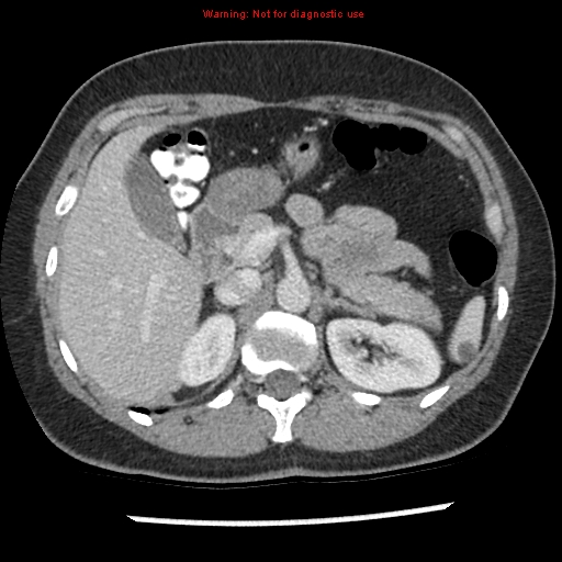Acute appendicitis (Radiopaedia 7966-8812 C+ portal venous phase 9).jpg