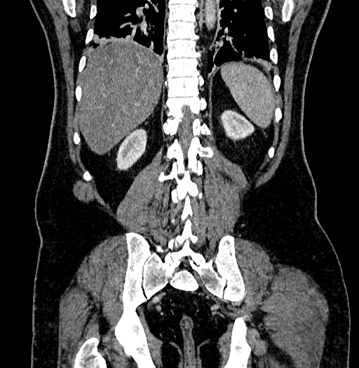 Acute appendicitis (Radiopaedia 79950-93224 Coronal C+ portal venous phase 72).jpg