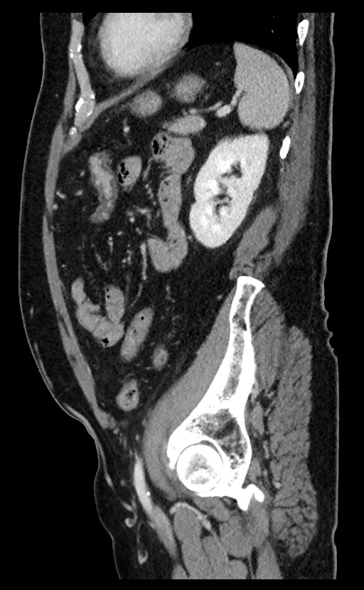 Acute appendicitis - large appendicoliths (Radiopaedia 61805-69820 Sagittal C+ portal venous phase 32).jpg