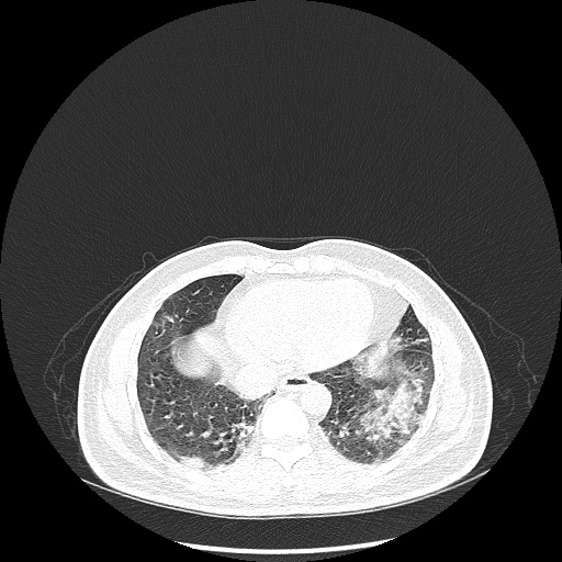 File:Acute appendicitis and COVID 19 pneumonia (Radiopaedia 76604-88380 Axial lung window 41).jpg